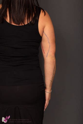 Brachioplasty Arm Reduction Scars Dr Gavin Sandercoe