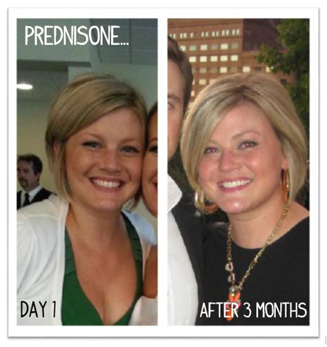 The Maren Update Ode To Prednisone The A Hole That Coined The Term