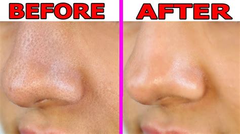 How To Shrink Large Pores On Nose Overnight Large Pores On Nose