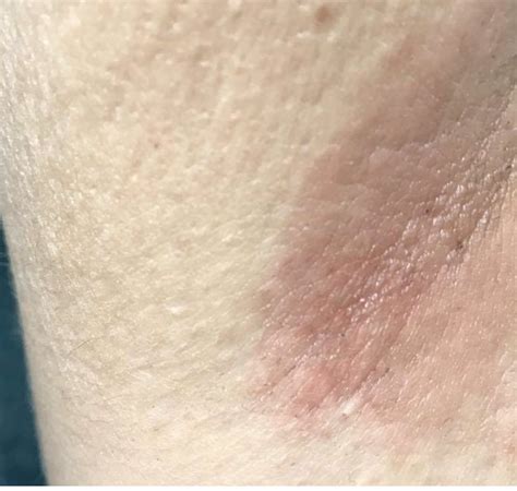 Skin Rash Under Armpit