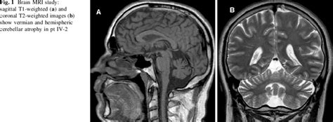 Brain Mri Study Sagittal T1 Weighted A And Coronal T2 Weighted