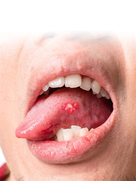 Oral Herpes Under Tongue