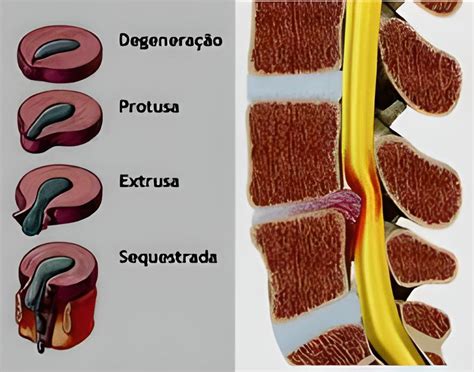 Hérnia De Disco Dr Henrique Noronha