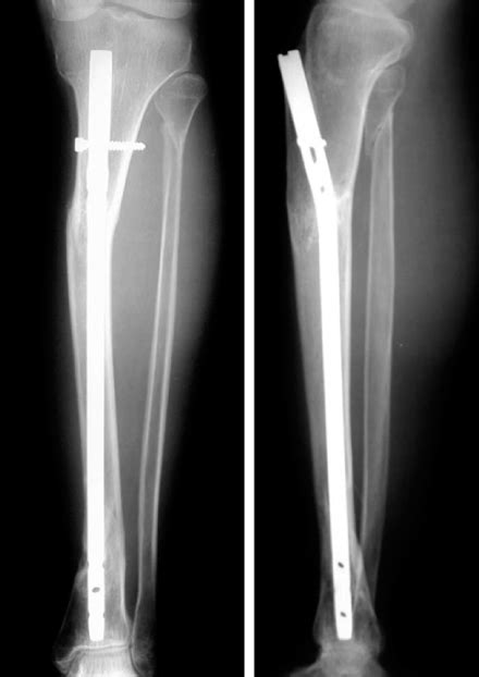 Proximal Third Tibia Fracture Trauma Orthobullets