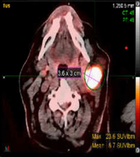 Pet Ct Scan That Demonstrates A Fdg Avid Ill Defined Left Level 2