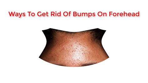 Bumps On Forehead Best Ways To Get Rid Of Bumps On Forehead How To