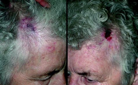 Scalp Lesions In A 78 Year Old Woman Cmaj