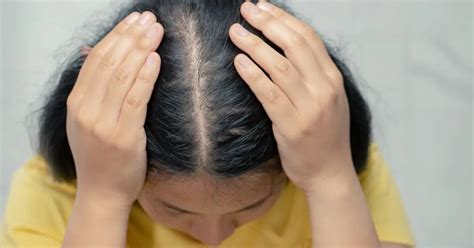 Lupus Hair Loss Its Symptoms Causes Treatment And Prevention