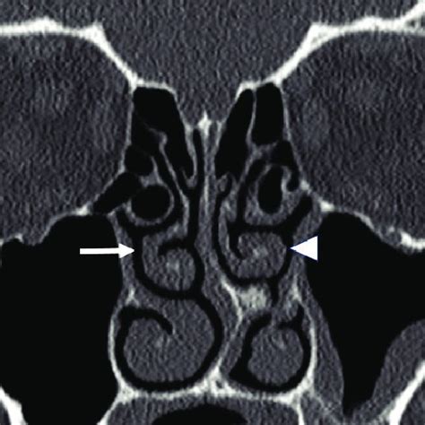 Coronal Ct Scan At The Level Of Sphenoid Sinus Showing The Critical