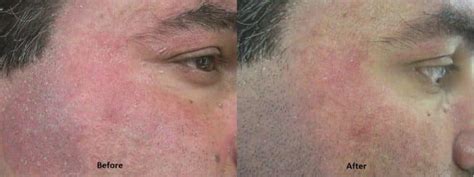 Rosacea Treatment Solihull Medical Cosmetic Clinic
