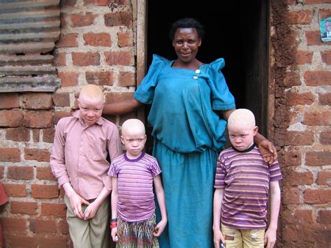 How To Prevent Albinism Understandingbench16