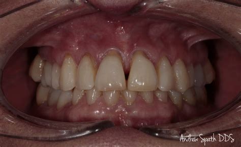 Invisalign And Tooth Height Correction Case Study General And Cosmetic