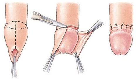 What Happens During Infant Circumcision Images Description Pain Surgery YourTango