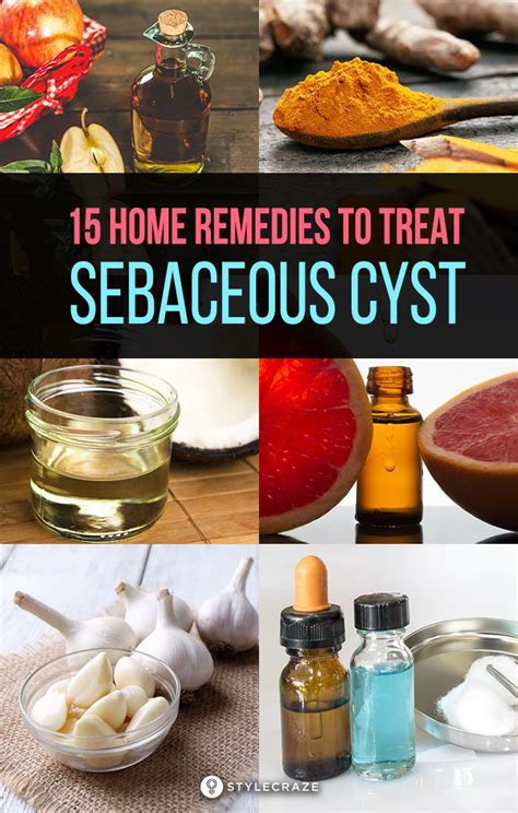14 Home Remedies To Treat Sebaceous Cysts Home Remedies Remedies