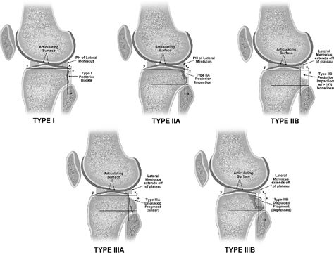 Figure 1 From Morphologic Variants Of Posterolateral Tibial Plateau