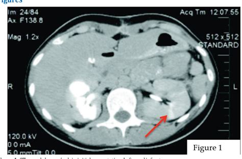 Figure 1 From Catastrophic Antiphospholipid Syndrome A Rare But Serious Complication Of