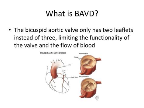 Ppt Bicuspid Aortic Valve Disease Powerpoint