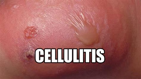 Cellulitis What Is It Treatments Causes And Symptoms Youtube
