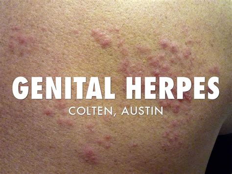 Genital Herpes By Colten Stevens
