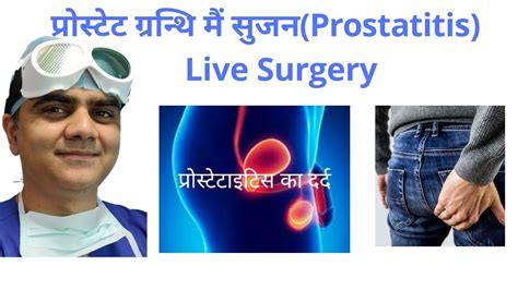 Chronic Prostatitis Surgical Management With Live Surgery Laser Operation Of Prostatitis YouTube