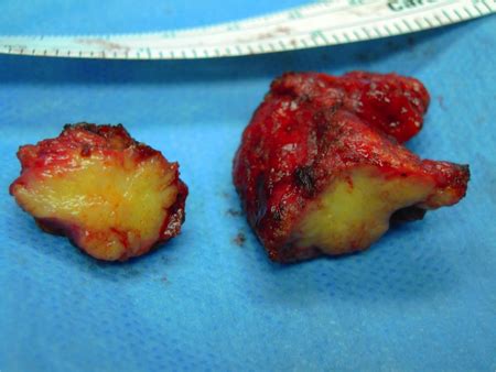 The cancer usually presents as a single reddish or purple lump on a part of the skin that is often exposed to. Merkel Cell Carcinoma - American Academy of Ophthalmology