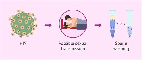 Sexual Transmission Of Hiv And Assisted Reproduction