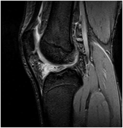 Sagittal Proton Density Weighted Mri Of The Knee Of A Year Old Male Download Scientific