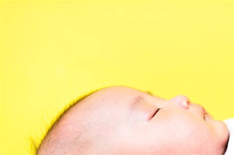 Understanding Baby Acne