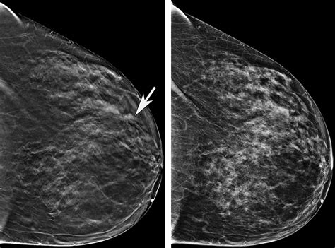 D Mammography Creates More Precise Images To Detect Breast Cancer