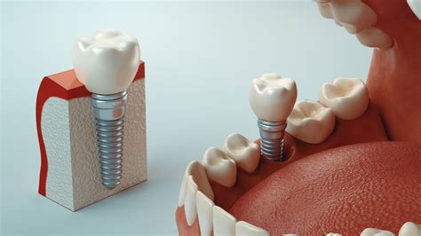 Implantes De Carga Inmediata Clínica Dental Imoi