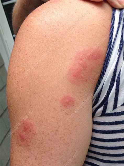 Bed Bug Bites Line