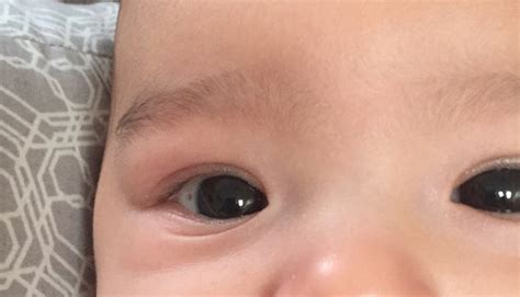 Red Dot In The Eye Babycenter