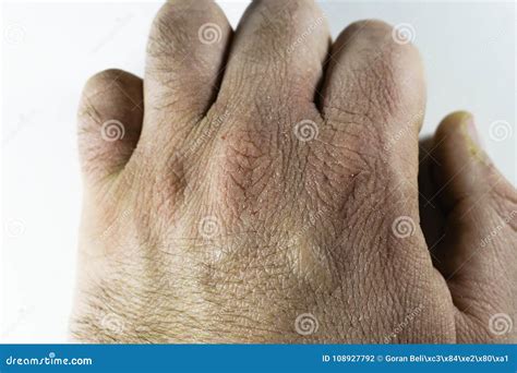 Close View Of Dry And Cracked Hand Knuckles Skin Problem Stock Photo