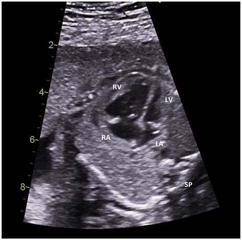 First Trimester Diagnosis Of Hypoplastic Left Heart Syndrome A Case