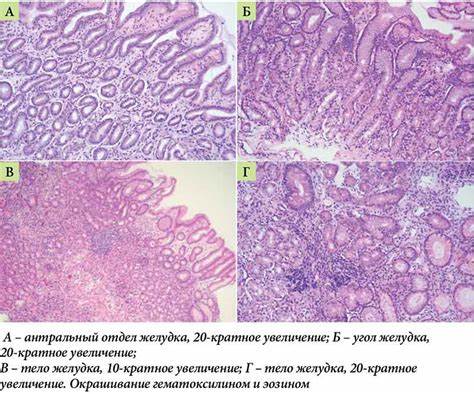 Гастрит как правильно диета Классификация Атрофического Гастрита По Кимура Такемото - 68 фото Классификация Атрофического Гастрита По Кимура Такемото - 68 фото Гастрит как правильно диета