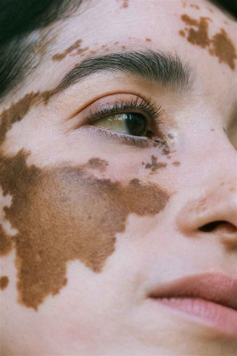 20 Photos Incroyables De La Beauté Des Personnes Atteintes De Vitiligo