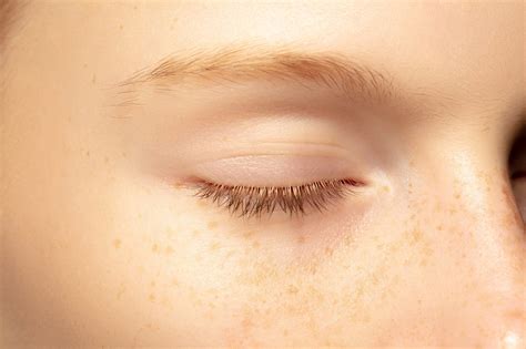 How To Get Rid Of Chicken Skin Under Eyes Causes Treatment And Milia