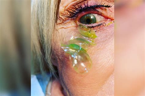 Video Shows Doctor Removing 23 Contacts From Woman S Eye