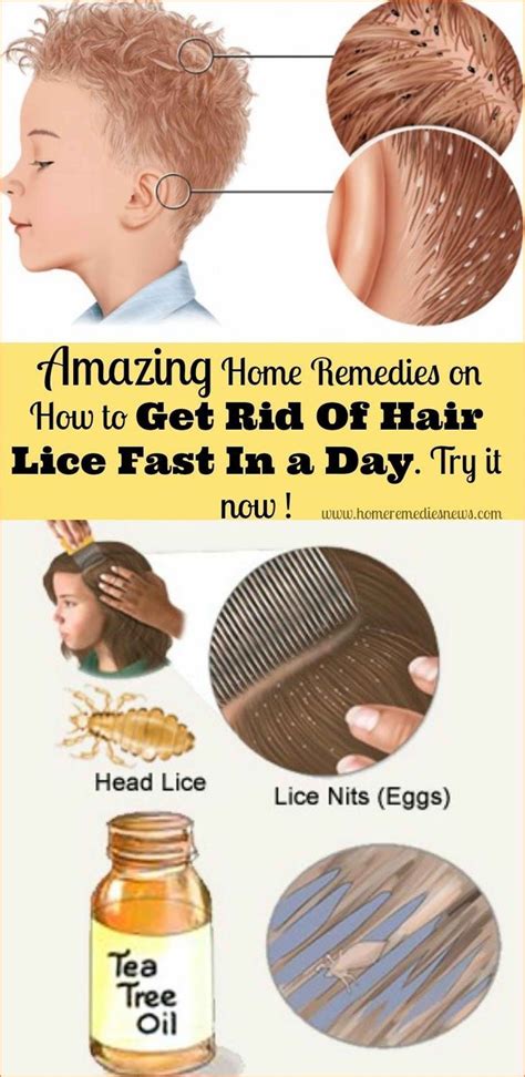How To Get Rid Of Head Lice In One Day Hair Lice Home Remedies Remedies