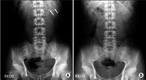 A Preoperative Kidney Ureter Bladder Kub Abdominal Radiograph Of A
