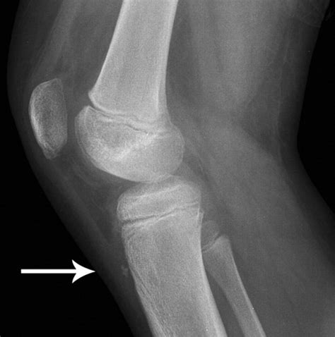 Injuries And Conditions Of The Extensor Mechanism Of The Pediatric Knee