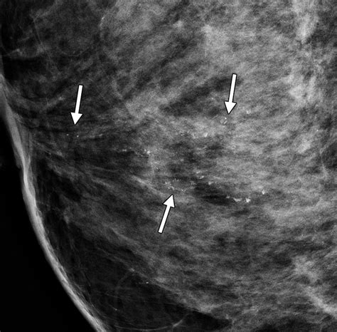 Grouped Amorphous Calcifications At Mammography Frequently Atypical But Rarely Associated With