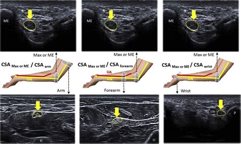 Ultrasound Parameters Other Than The Direct Measurement Of Ulnar Nerve