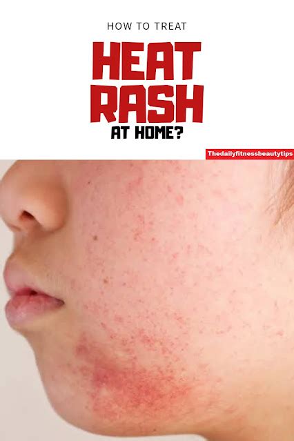 How To Treat Heat Rash