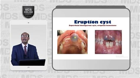 5 2 Dentigerous Cyst Varient Eruption Cyst 6 1 Lateral Periodontal Cyst