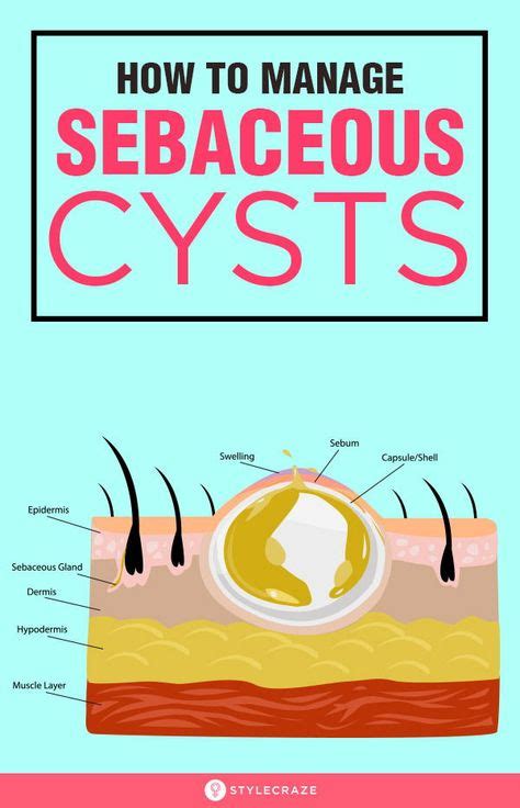 14 Home Remedies To Treat Sebaceous Cysts Cysts Skin Natural