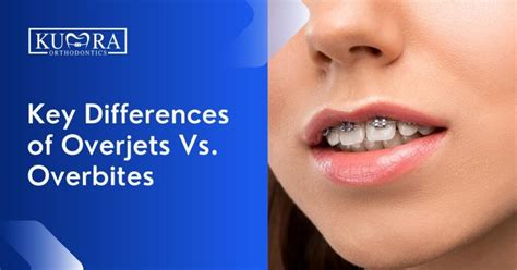 Differences Of Overjets Vs Overbites And How To Treat Them Kumra