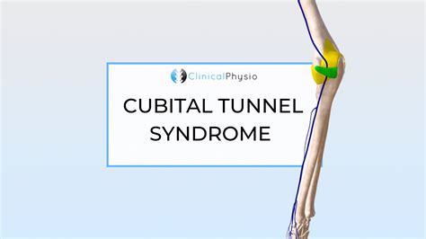 Cubital Tunnel Syndrome Clinical Physio Membership