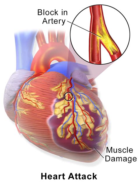 Myocardial Infarction Mi Signs And Symptoms Diagnosis Management