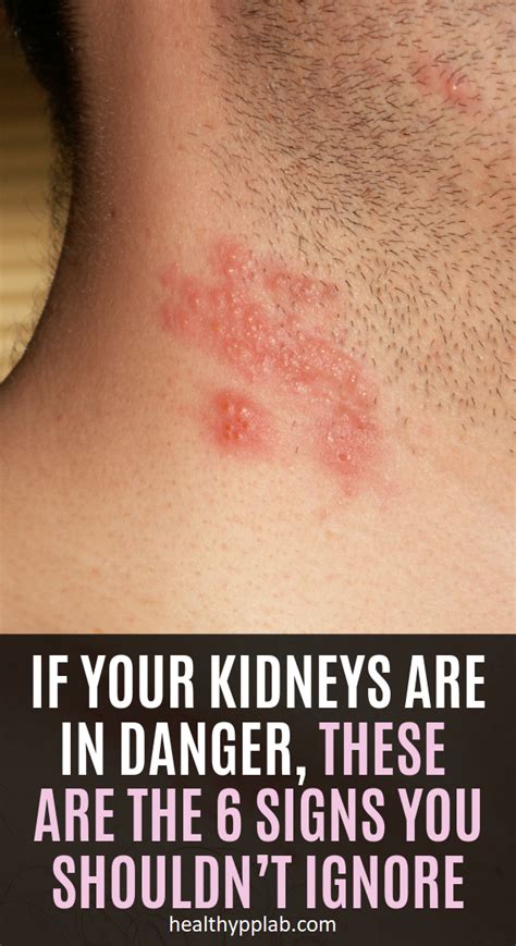 If Your Kidneys Are In Danger These Are The 6 Signs You Shouldnt